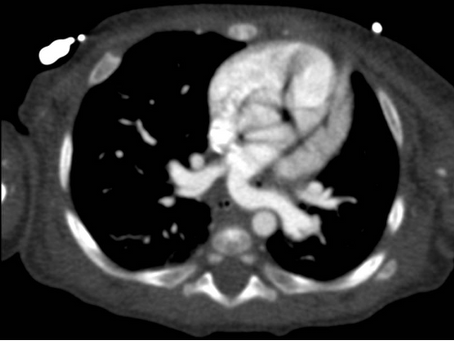 Caso del Mes: Sling de la Pulmonar – Junio 2022