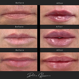 Lip Injections Kingston, Lip Injections 0.5ML Kingston, Lip Injections Kingston before and after
