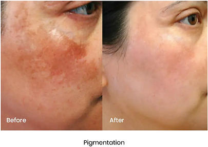 Pigmentation.png