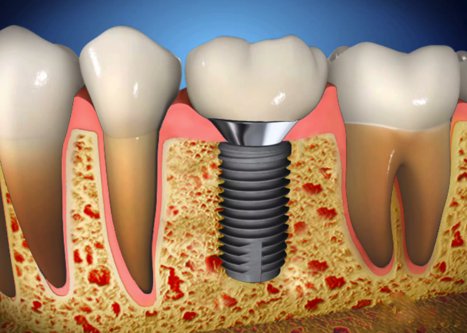 Dental Implants