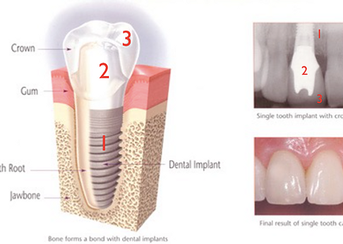 dental implant parts explained