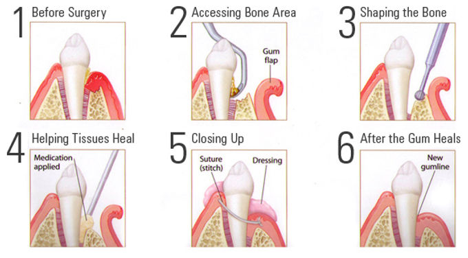 Gum surgery