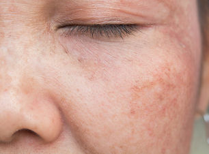 melasma.jpg