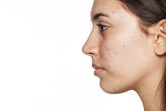 microneedling Essonne, acné, rougeur, rides