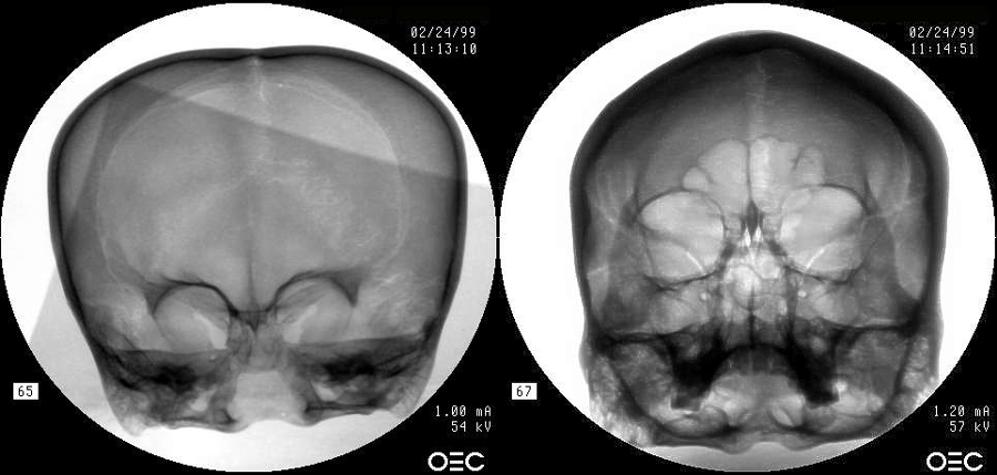 Frontal Comparison