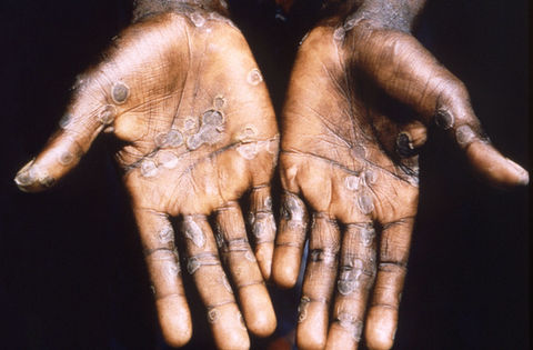 mRNA vaccines could help halt mpox spread, experts say - Tides Global