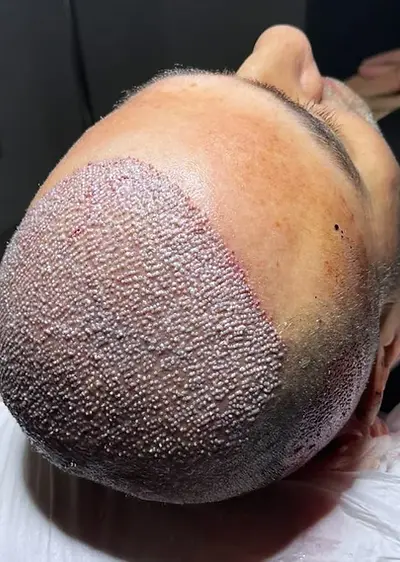 FUE-technique-1024x768.jpg.webp