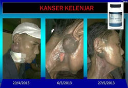 Kanker Kelenjar.jpg