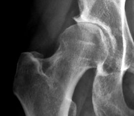 HPC_Osteoarthritis_edited.jpg