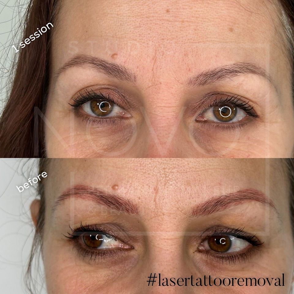Laser Colour Correction of permanent makeup