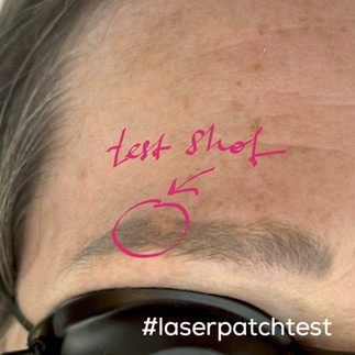 laser tattoo removal patch test