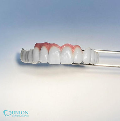 Fixed Dental Prosthesis