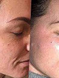 Peeling Vorher Nachher Resultate Rosemi Beauty Studio Luzern kosmetikstudio Hautstraffung
