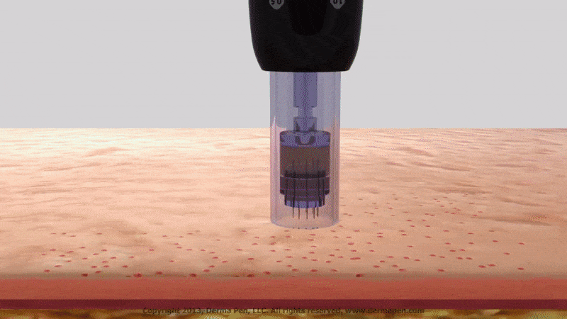 mezoterapija-dermapen.gif