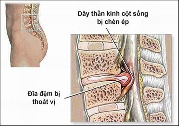 Bạn biết gì về thoát vị đĩa đệm cột sống thắt lưng