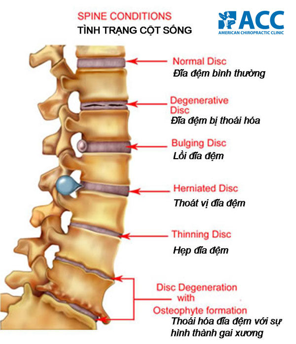 Chữa trị hiệu quả và dứt điểm các vấn đề cột sống không sử dụng thuốc