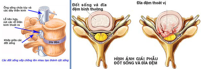 Bệnh thoát vị điều trị chữa bằng phương pháp nào tốt