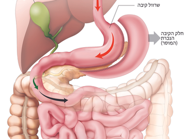 לנצח עם השרוול - תוצאות ארוכות טווח של ניתוח שרוול קיבה