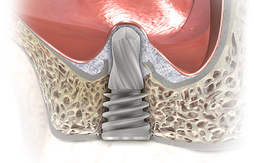 SINUS FLOOR ELEVATION