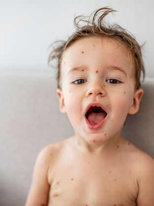 NHS Chickenpox vaccination 2026