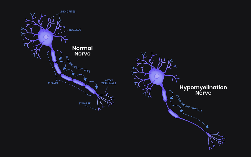 Normal nerve compared to a hypomyelination nerve
