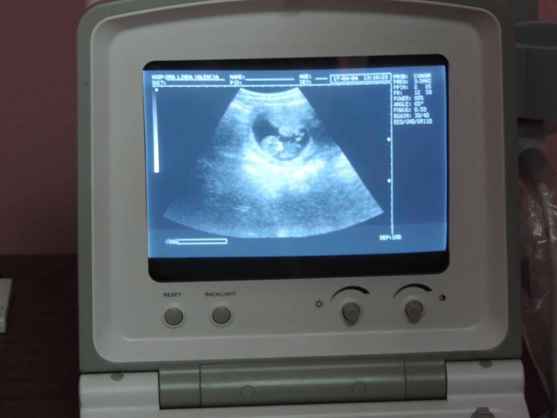 Ultrasound 11 weeks