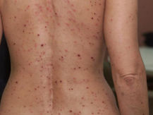 MANTIENE SESA VIGILANCIA EPIDEMIOLÓGICA CON LA VIRUELA SÍMICA.
