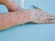 SECRETARÍA DE SALUD DA A CONOCER MEDIDAS PREVENTIVAS CONTRA LA VIRUELA SÍMICA.