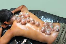 hijama0