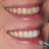 Veneers