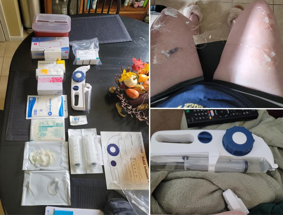 A three-panel collage showing subcutaneous infusion therapy equipment. Left panel shows medical supplies spread across a dark table including syringes, tubing, packaging, and a Freedom60 SubQ Infusion pump kit. Upper right panel shows both legs with subcutaneous infusion needles and clear tubing attached at multiple sites. Lower right panel shows a close-up of the Freedom60 infusion pump device.