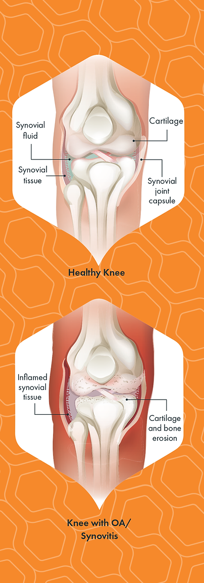 Healthy Knee vs. OA Knee.png
