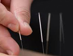 Acupunctuur