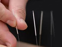 Acupunctuur