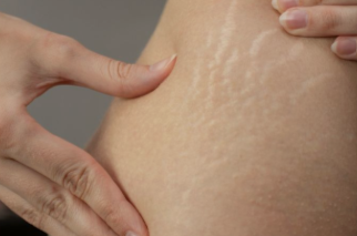 Que faire contre les vergetures ? Prévention avant tout 🌿