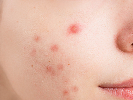 Conseils de Tati Houda : Vos boutons vous complexent ?Comment les gérer sans filtres ni maquillage