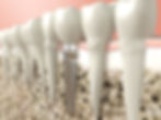 Implant surgery