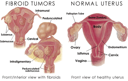 Fibroid Tumors and normal Uterus