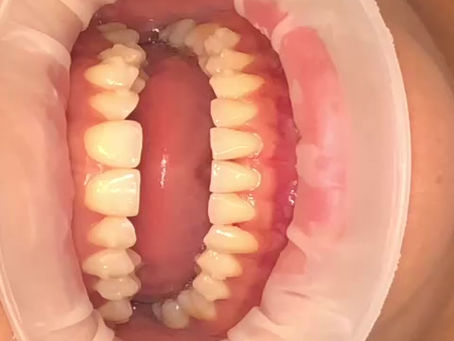 Ever wondered why IPR is needed during Invisalign Treatment?