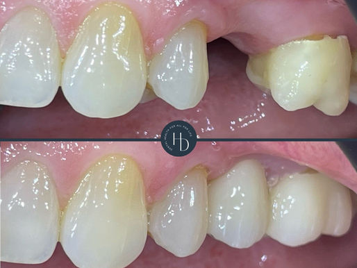 What is a Dental Bridge? 