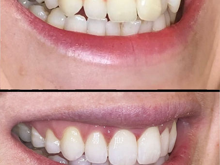 Transform Your Smile with Invisalign: The Benefits of Straightening Your Teeth