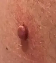 skin tags.webp