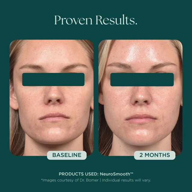 Thumbnail: Marini SkinSolutions NeuroSmooth®