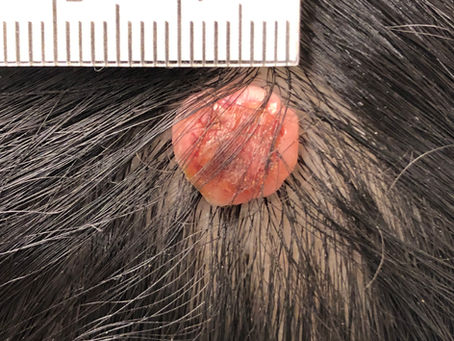 軟性線維腫 第2報