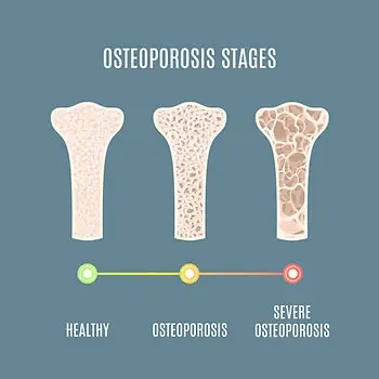 Bone mineral density changes in stages of osteoporosis