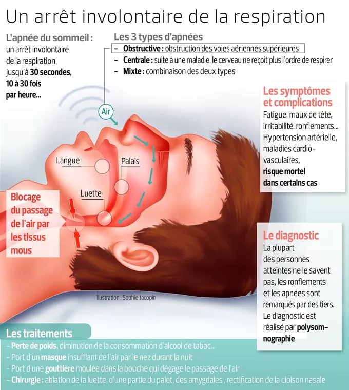 Apnées du sommeil : les patients sous PPC inobservants bientôt désappareillés ?