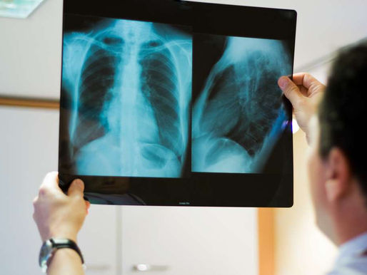 Les problèmes respiratoires post-Covid associés à des anomalies pulmonaires indétectables en routine