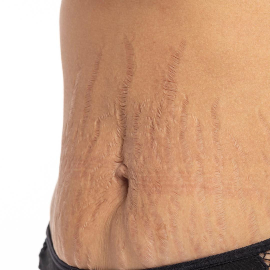 Polynucleotide Treatement