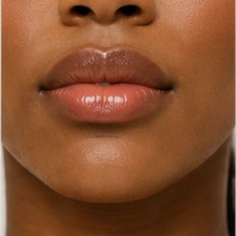 Lip Augmentation 1ml