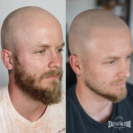 tetovanie vlasov hair tattoo smp mikropigmentácia